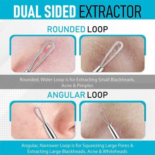 Professional Blackhead Extractor Tool (Stainless Steel) Pimple Popper for Acne, Whiteheads, and Blackheads Best for Facial Skin Care and Pore Minimization