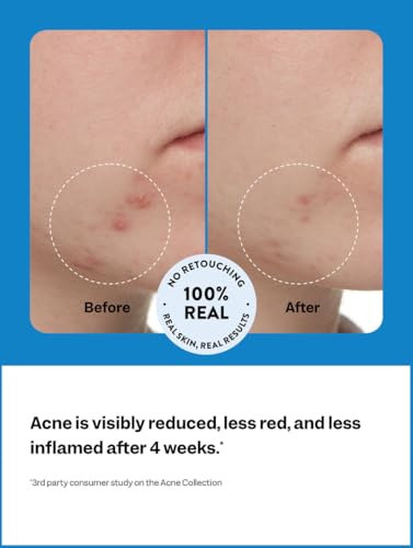 Peach Slices 3-Step Acne Starter Kit