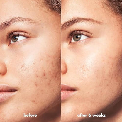 e.l.f. SKIN Blemish Breakthrough Triple-Acid Resurfacing Serum, Hydrating Night Serum For Fighting Blemishes, Helps Improve Skin Tone & Texture