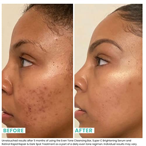 Urban Skin Rx® Even Tone Cleansing Bar | 3-in-1 Multitasking Treatment Daily Cleanser, Exfoliator, & Mask | Targets Uneven Skin & Improves the Appearance of Dark Spots | Includes Applicator | 2.0 Oz