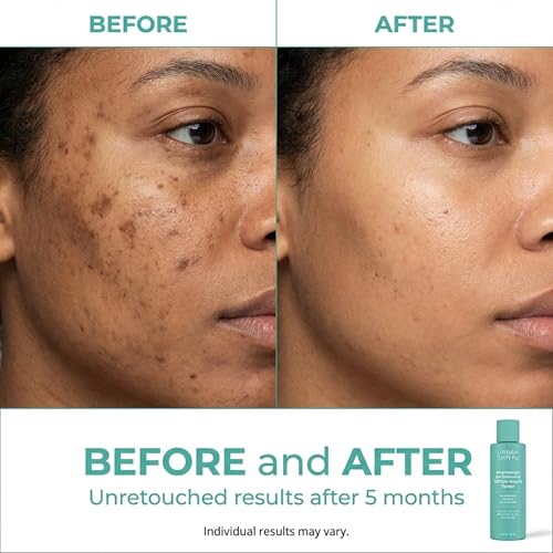 Urban Skin Rx Witch Hazel Brightening & pH Balancing Toner, Exfoliated & Clarifies Clogged Pores, Improves the Appearance of Uneven Skin Tone, Reduces Redness & Brightens Dull Complexions, 4.5 Fl Oz
