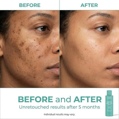 Urban Skin Rx Witch Hazel Brightening & pH Balancing Toner, Exfoliated & Clarifies Clogged Pores, Improves the Appearance of Uneven Skin Tone, Reduces Redness & Brightens Dull Complexions, 4.5 Fl Oz